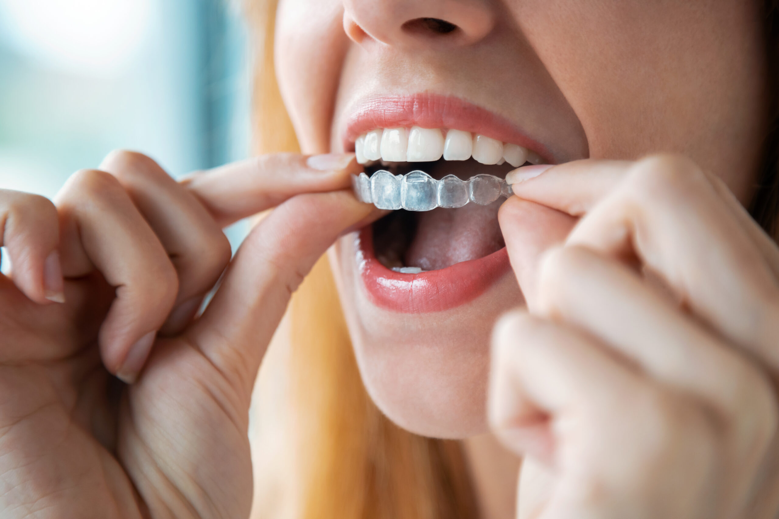Marion Clear Aligners