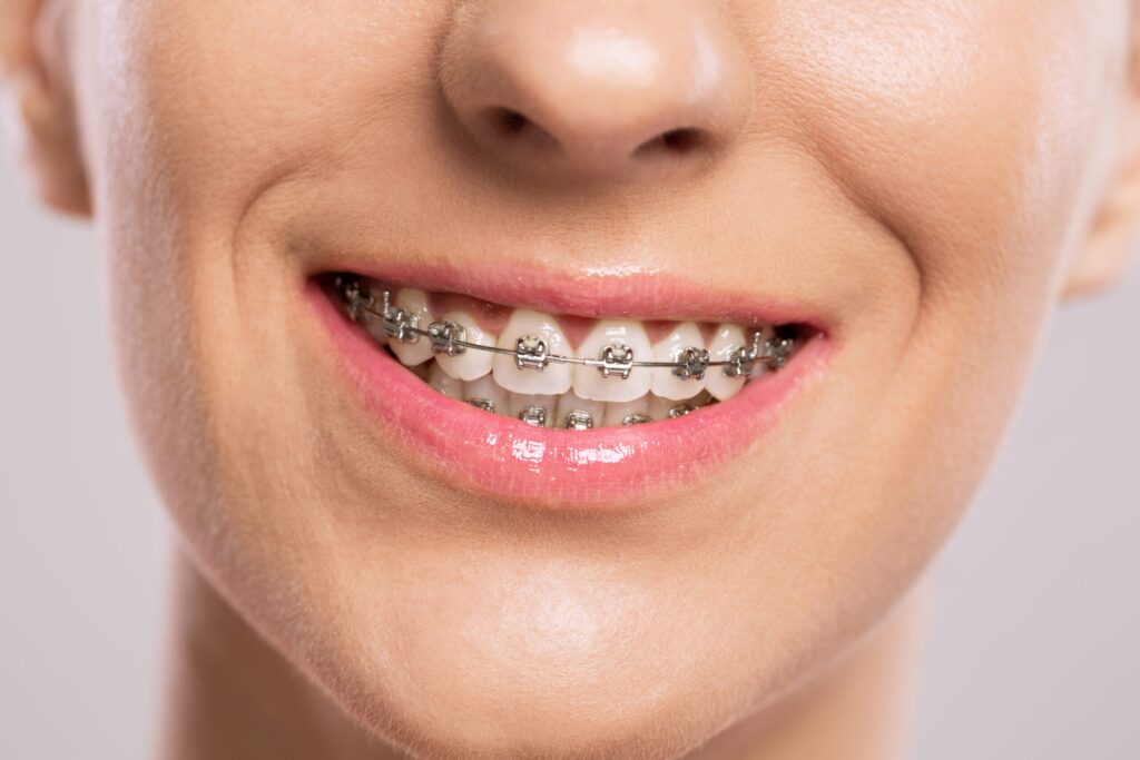 Metal Braces vs. Clear Braces: Which Is Right for You?